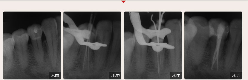 順德德倫口腔醫(yī)生全國根管治療技術(shù)競賽案例