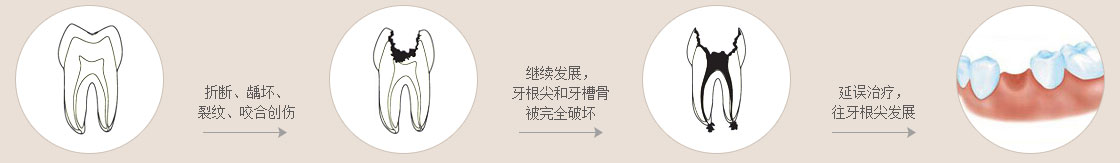 從牙髓炎到根尖炎的病變過程
