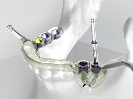 數字化種植技術