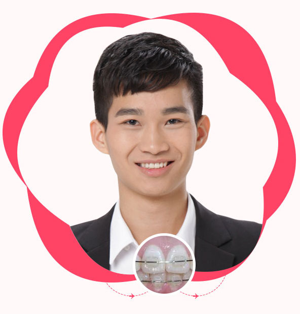 自鎖陶瓷托槽迷你正畸