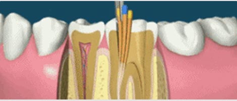 中重度牙周病方案微創(chuàng)根管治療術(shù)